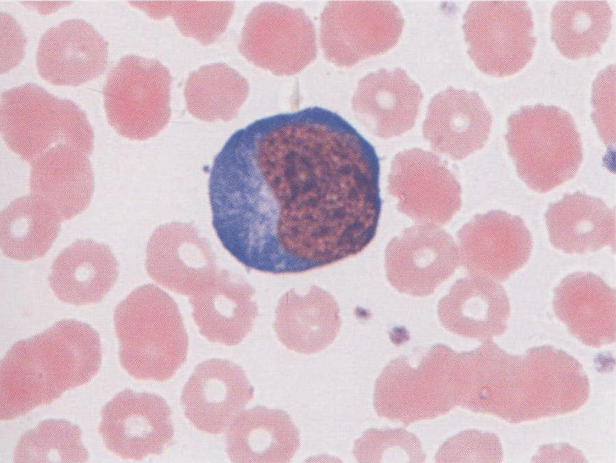 异型淋巴细胞